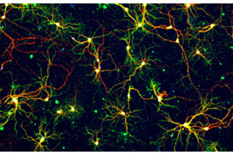 Alzheimers-neurons.jpg