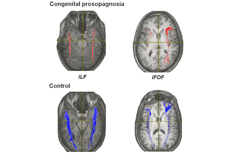 Prosopagnosiawhitematter.jpg