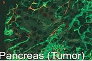 pancreatic-tumor.jpg