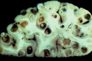 Taenia solium, Tapeworms in Brain - Theodore Nash