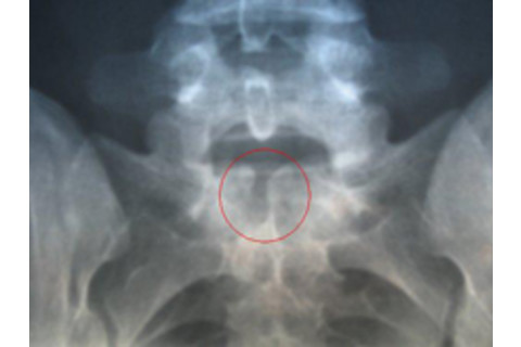 Spina_Bifida.jpg