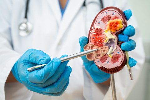 Doctor holding kidney model explaining chronic kidney disease