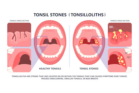 Cross section of healthy tonsils vs tonsil stones