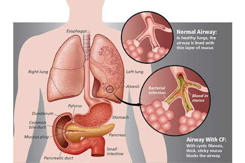 Cystic Fibrosis Infograph - Jay Smith