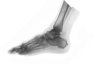 Foot X-ray - Shutterstock