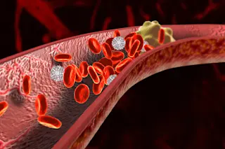 Blood Clot - Shutterstock