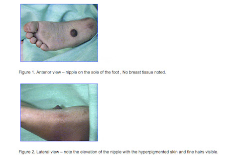 nipple_foot_images.jpg