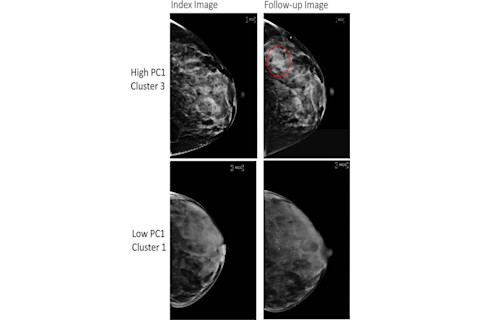 mammogram image