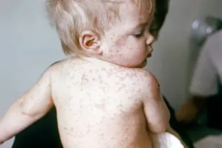 measles