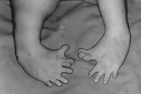 Solving a 50-Year Mystery: How Thalidomide Causes Birth Defects