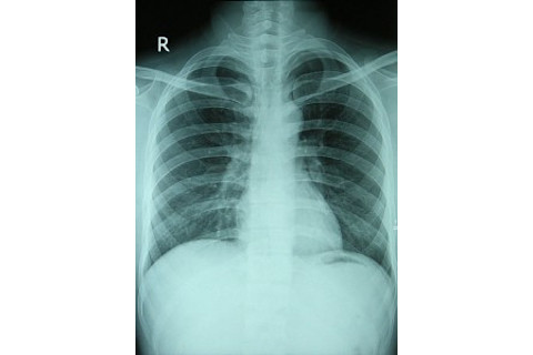chest_xray_normal-221x300.jpg