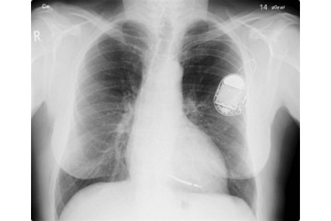 pacemaker-e1308248005250.jpg