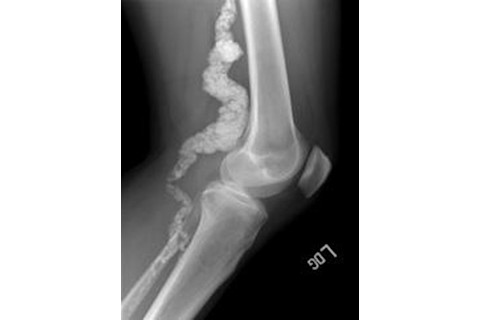 bonedisease.jpg