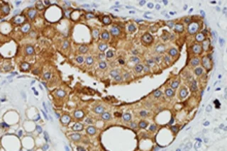 prostate-cancer-cells.jpg