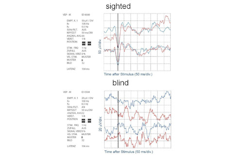 Sighted versus blind VEPs chart