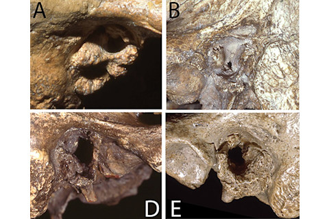 Neanderthal Exostoses - PLOS One