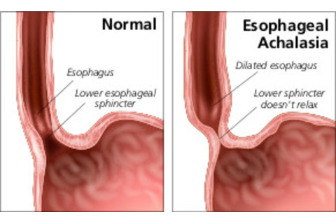 Esophogeal Sphincter - Shutterstock