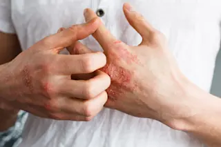 Eczema - Shutterstock