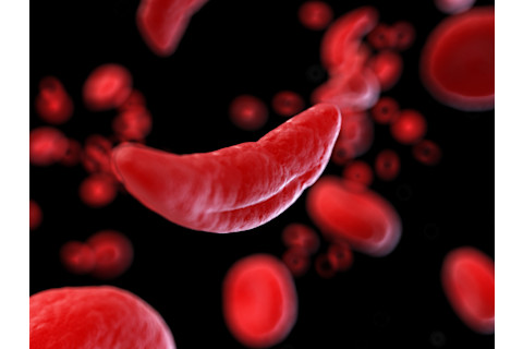 sickle cell - shutterstock