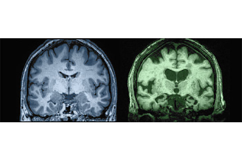 27 year old vs. 87 year old subarachnoid space brain comparison