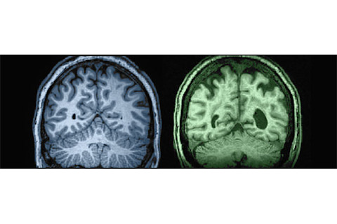 27 year old vs. 87 year old white matter brain comparison