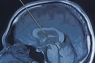 deep brain stimulation concept probe parkinsons disease - shutterstock