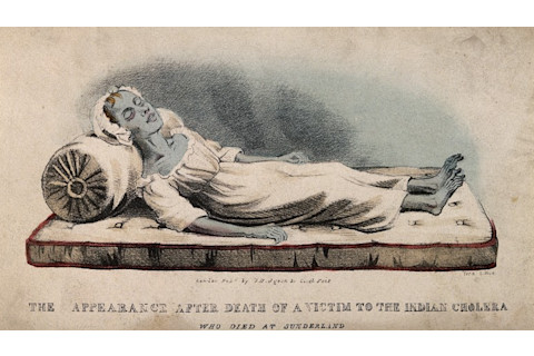A colored lithograph by from 1832 of a deceased cholera victim. Note the blue complexion, sunken face, and emaciated extremities. Source: Wellcome Collection. Click for source.