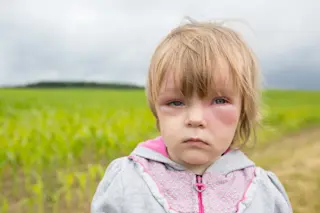 Child With Swelling