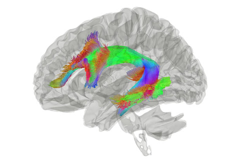I-arcuate-fasciculus