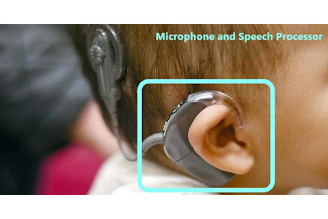 Cochlear Implants 6