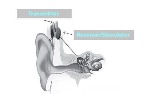 Cochlear Implants 8