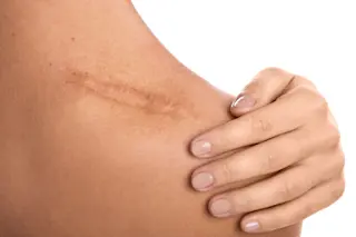 Woman w/ scar