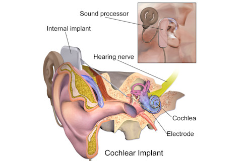 Science and Miracle of Cochlear Implants 4