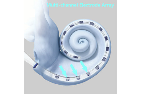 Science and Miracle of Cochlear Implants 9