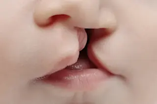 cleft lip and palate