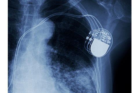 pacemaker