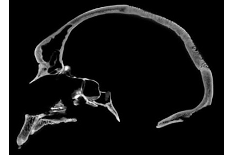CT-scan-Kabwe