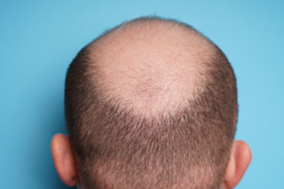 Balding head