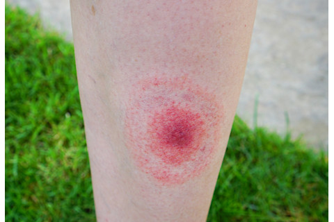 Lyme disease, Borreliosis or Borrelia, typical lyme rash, spot. A person, leg bitten by a deer tick.