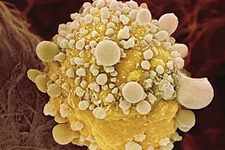 Pancreatic Cancer Cells - Science Source