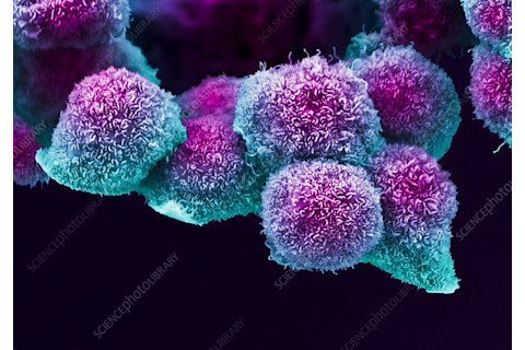 C0460869-Pancreatic cancer cell, SEM
