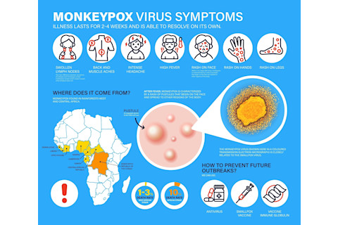 Monkeypox virus Symptoms. New cases of Monkeypox virus are reported in Europe and USA. Monkeypox is spreading in the Europe. It cause skin infections. Monkeypox virus detailed infographics