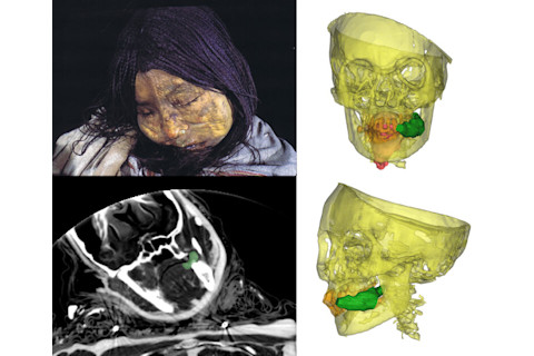 This frozen mummy was found entombed near the top of the Llullaillaco volcano in northwest Argentina.