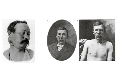 For Zola (left), Coley's toxin-triggered infection liquefied the tumor in days. But toxin-induced infections were unpredictable; the patient at right had 63 injections before his tumor shrank. Some patients died.