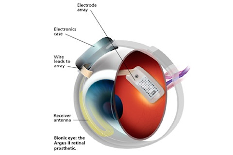 bionic-eye
