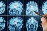 Doctor pointing at something on a brain MRI image