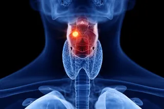 Voice box cancer and AI detection