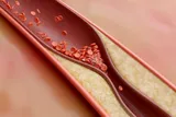 Blood clot near heart
