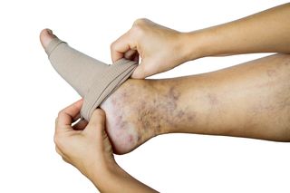 compression sock on leg with varicose veins compression sock on leg with varicose veins