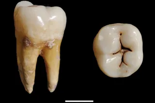 Iron Age sampled teeth from different views